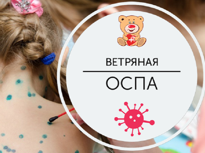 Профилактика ветряной оспы Профилактика ветряной оспы.